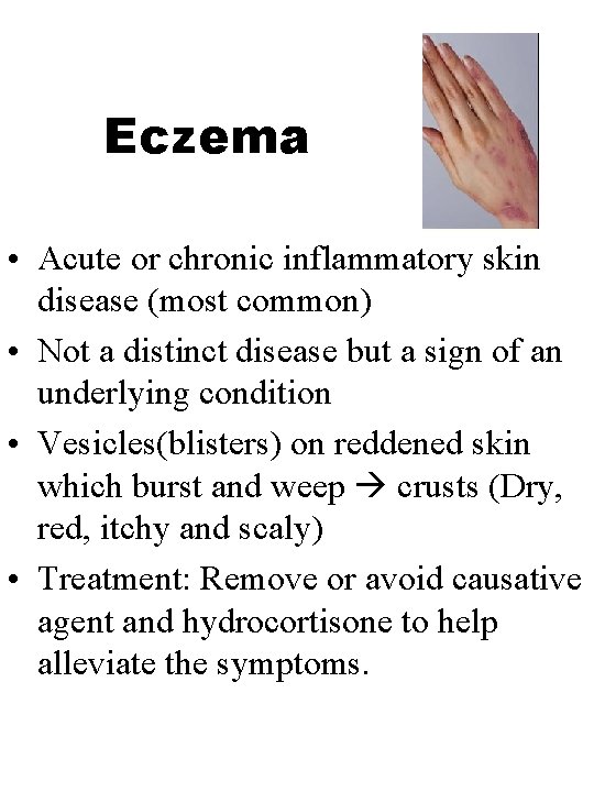 Eczema • Acute or chronic inflammatory skin disease (most common) • Not a distinct