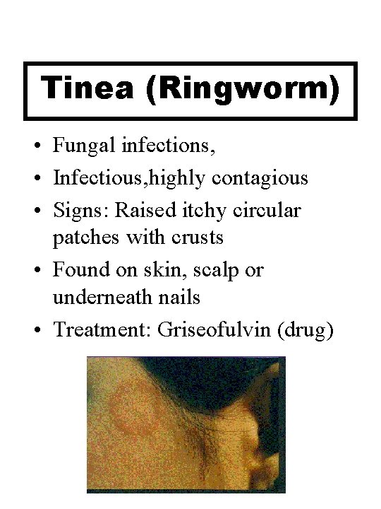 Tinea (Ringworm) • Fungal infections, • Infectious, highly contagious • Signs: Raised itchy circular