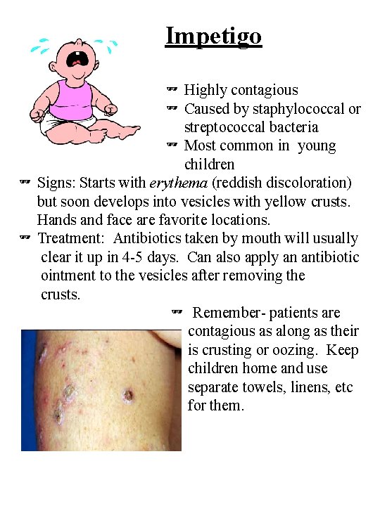 Impetigo Highly contagious Caused by staphylococcal or streptococcal bacteria Most common in young children