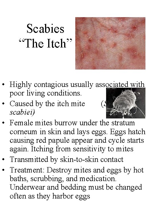 Scabies “The Itch” • Highly contagious usually associated with poor living conditions. • Caused