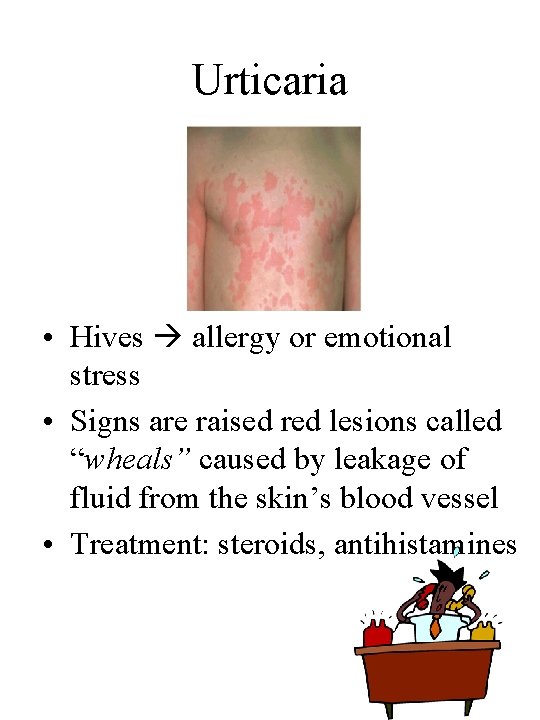 Urticaria • Hives allergy or emotional stress • Signs are raised red lesions called