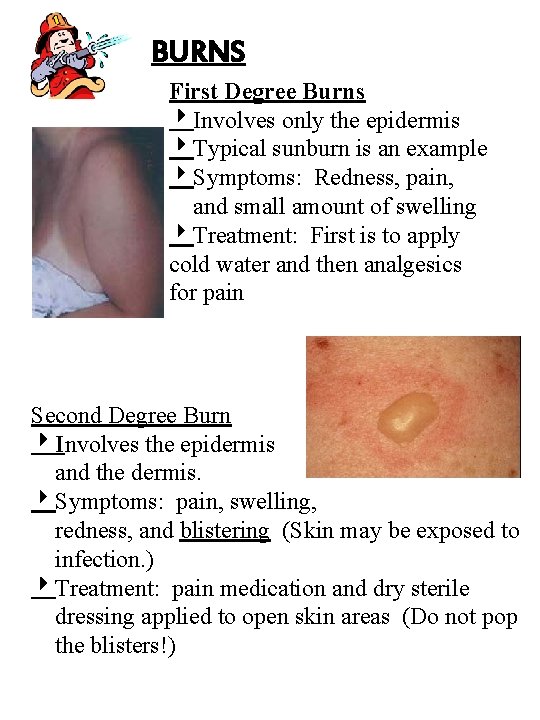 BURNS First Degree Burns Involves only the epidermis Typical sunburn is an example Symptoms: