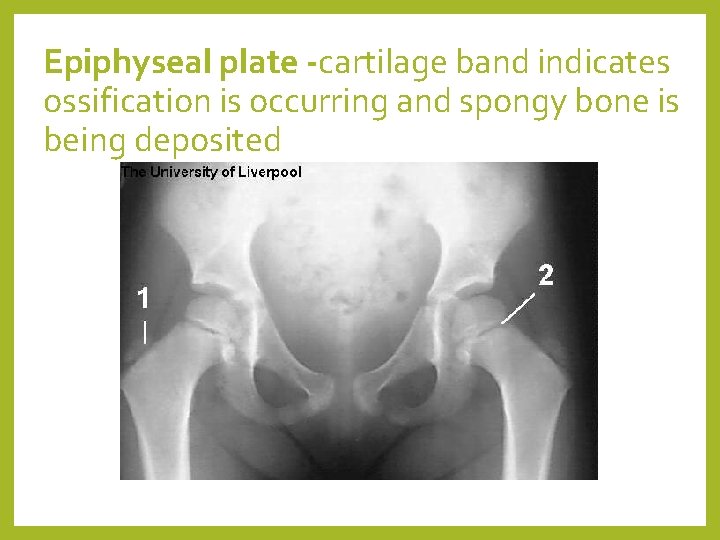 Epiphyseal plate -cartilage band indicates ossification is occurring and spongy bone is being deposited