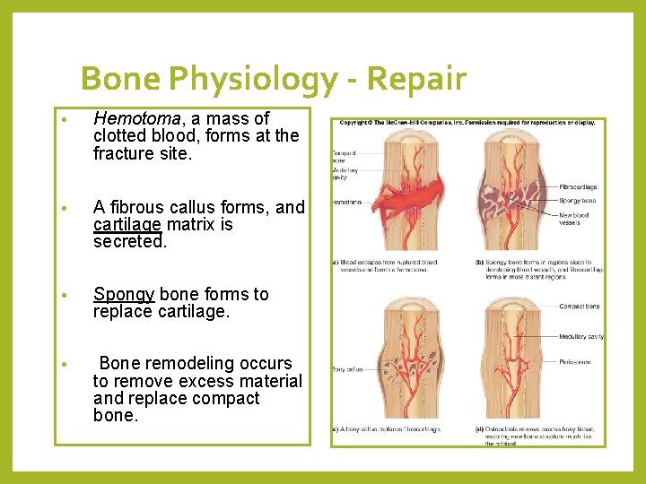 Bone Physiology - Repair • Hemotoma, a mass of clotted blood, forms at the