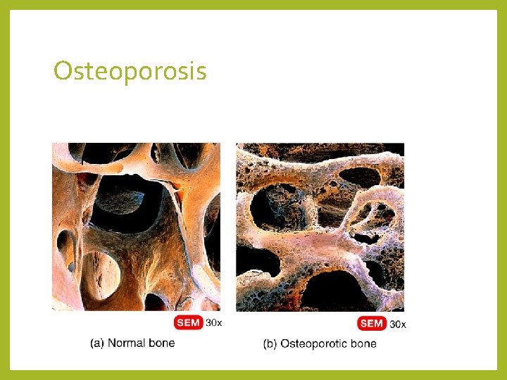 Osteoporosis 