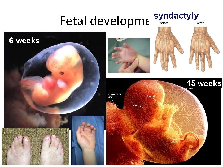 syndactyly Fetal development 6 weeks 15 weeks 