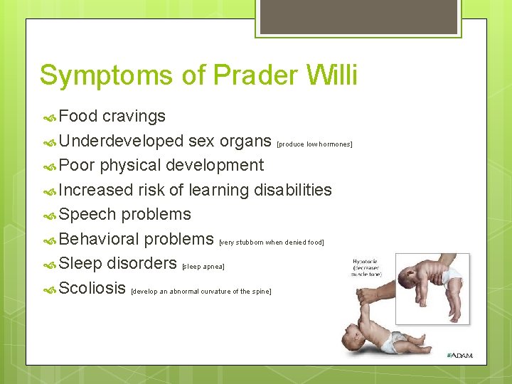 Symptoms of Prader Willi Food cravings Underdeveloped sex organs [produce low hormones] Poor physical