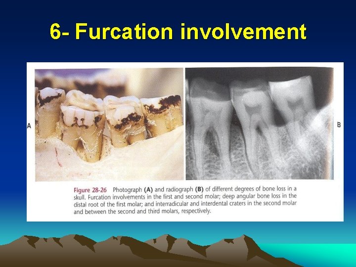 6 - Furcation involvement 