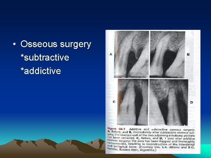  • Osseous surgery *subtractive *addictive 