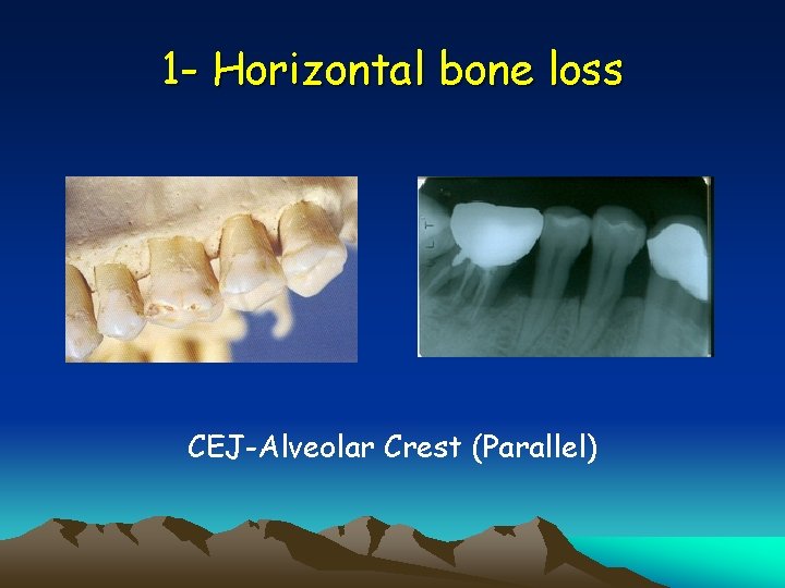 1 - Horizontal bone loss CEJ-Alveolar Crest (Parallel) 