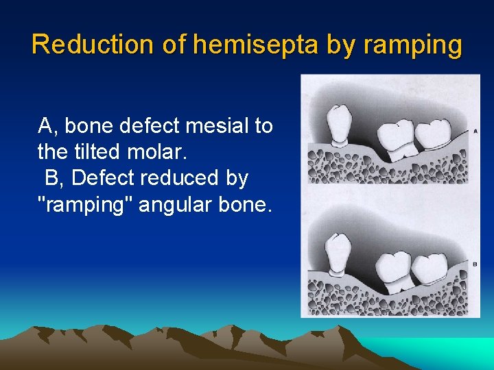Reduction of hemisepta by ramping A, bone defect mesial to the tilted molar. B,