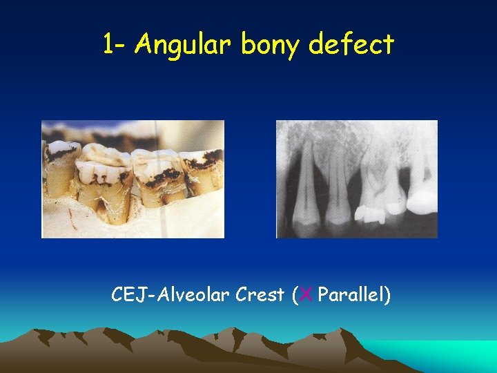 1 - Angular bony defect CEJ-Alveolar Crest (X Parallel) 