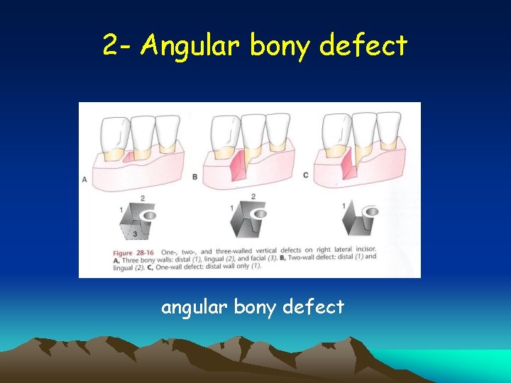 2 - Angular bony defect angular bony defect 