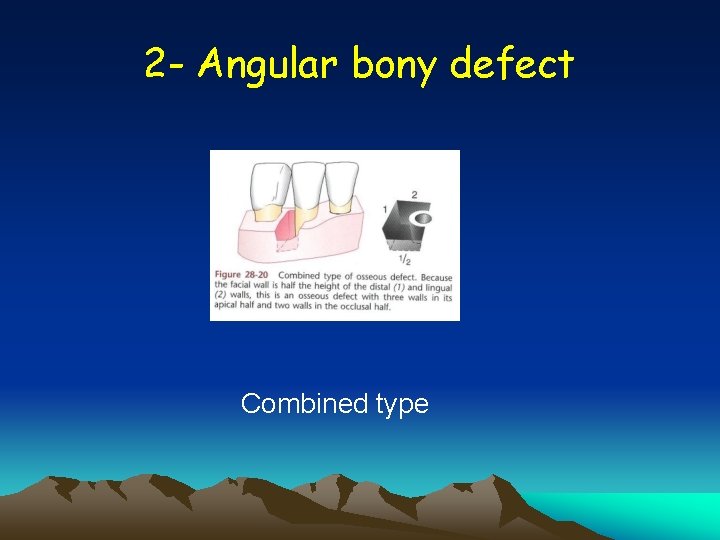 2 - Angular bony defect Combined type 