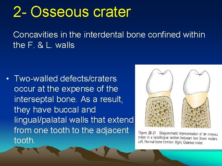 2 - Osseous crater Concavities in the interdental bone confined within the F. &