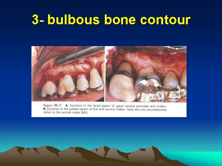 3 - bulbous bone contour 