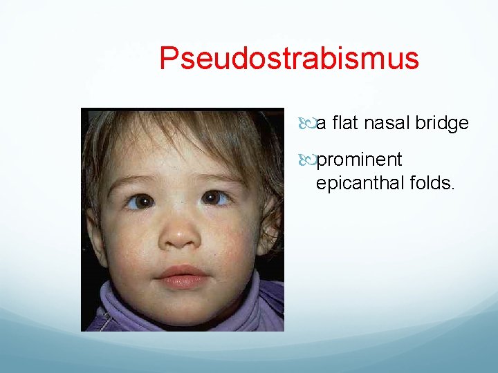 Pseudostrabismus a flat nasal bridge prominent epicanthal folds. 