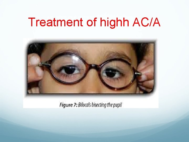 Treatment of highh AC/A 
