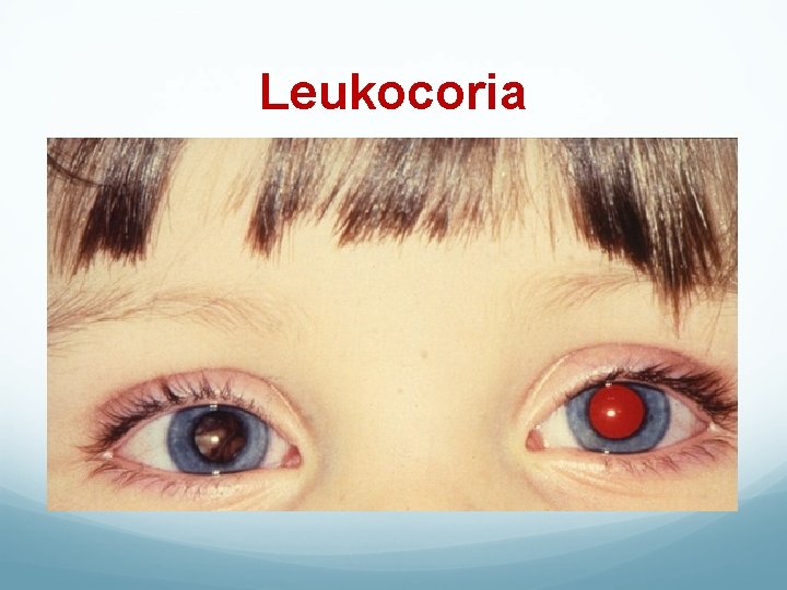 Leukocoria 