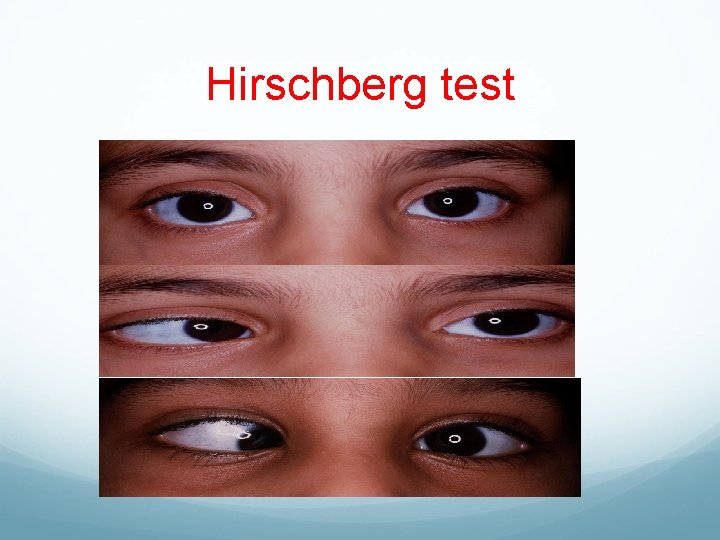 Hirschberg test 