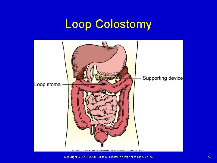 Loop Colostomy Copyright © 2013, 2009, 2005 by Mosby, an imprint of Elsevier Inc.