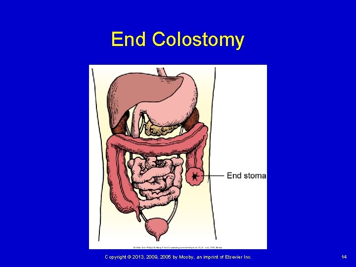 End Colostomy Copyright © 2013, 2009, 2005 by Mosby, an imprint of Elsevier Inc.