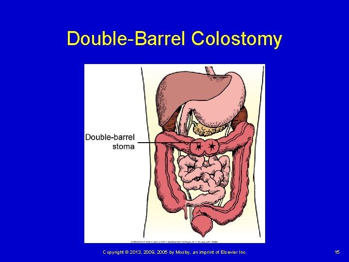 Double-Barrel Colostomy Copyright © 2013, 2009, 2005 by Mosby, an imprint of Elsevier Inc.