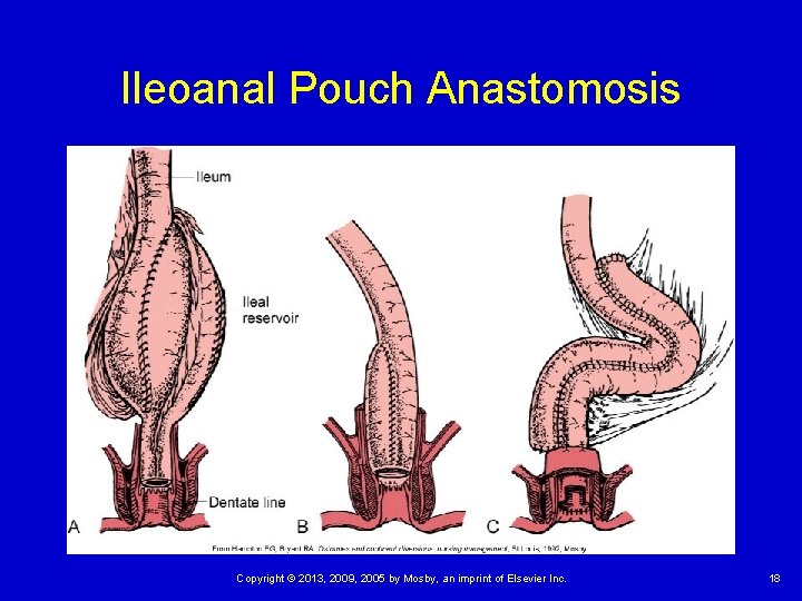 Ileoanal Pouch Anastomosis Copyright © 2013, 2009, 2005 by Mosby, an imprint of Elsevier