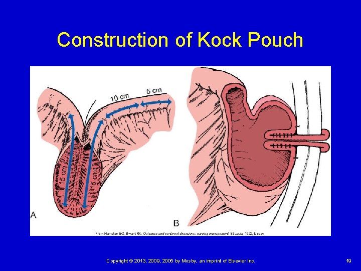 Construction of Kock Pouch Copyright © 2013, 2009, 2005 by Mosby, an imprint of
