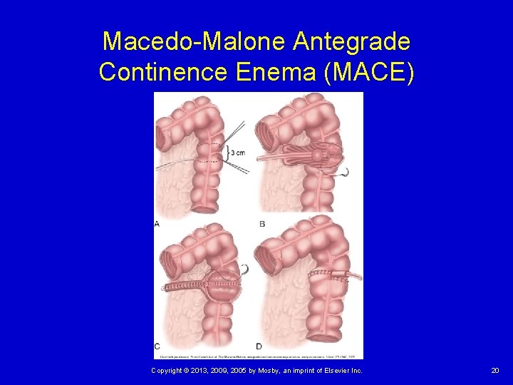 Macedo-Malone Antegrade Continence Enema (MACE) Copyright © 2013, 2009, 2005 by Mosby, an imprint