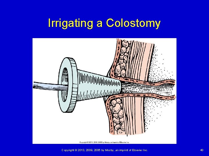 Irrigating a Colostomy Copyright © 2013, 2009, 2005 by Mosby, an imprint of Elsevier