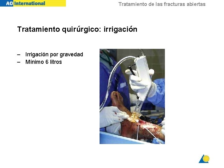 Tratamiento de las fracturas abiertas Tratamiento quirúrgico: irrigación – Irrigación por gravedad – Mínimo