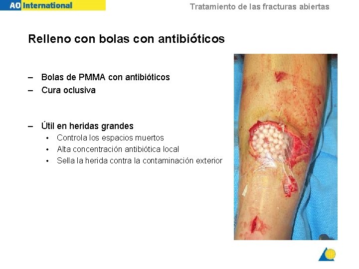 Tratamiento de las fracturas abiertas Relleno con bolas con antibióticos – Bolas de PMMA