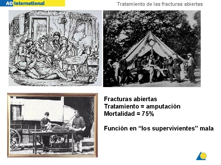 Tratamiento de las fracturas abiertas Fracturas abiertas Tratamiento = amputación Mortalidad = 75% Función