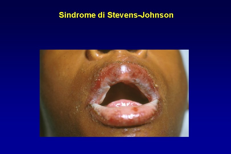 Sindrome di Stevens-Johnson 