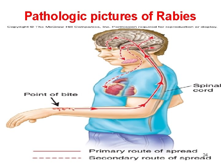 Pathologic pictures of Rabies 24 24 