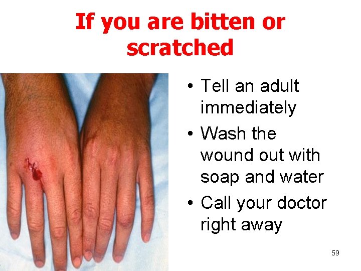 If you are bitten or scratched • Tell an adult immediately • Wash the