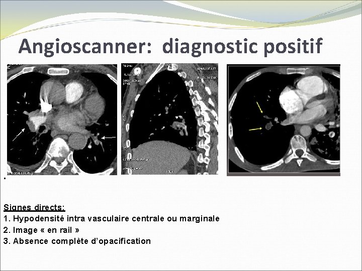Angioscanner: diagnostic positif . Signes directs: 1. Hypodensité intra vasculaire centrale ou marginale 2.