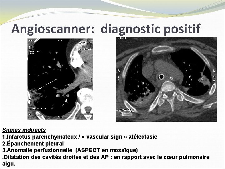 Angioscanner: diagnostic positif Signes indirects 1. Infarctus parenchymateux / « vascular sign » atélectasie