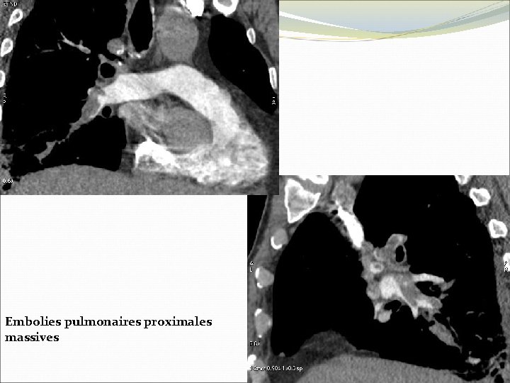 Embolies pulmonaires proximales massives 