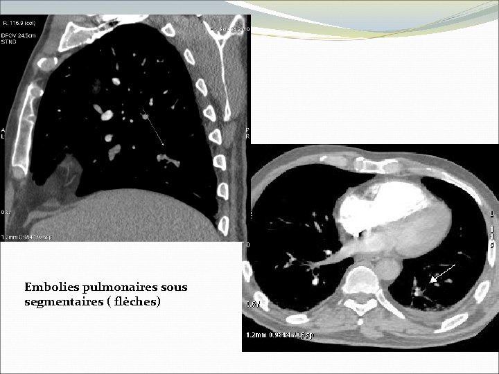 Embolies pulmonaires sous segmentaires ( flèches) 