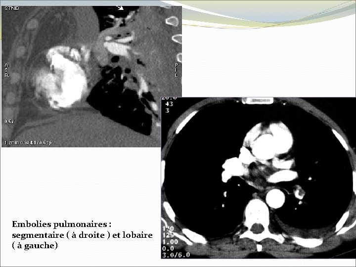Embolies pulmonaires : segmentaire ( à droite ) et lobaire ( à gauche) 