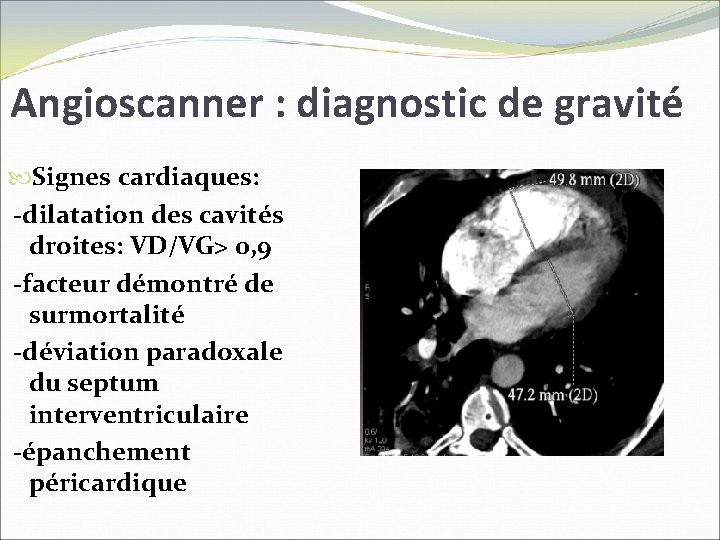 Angioscanner : diagnostic de gravité Signes cardiaques: -dilatation des cavités droites: VD/VG> 0, 9