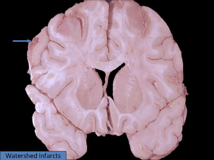 Watershed Infarcts 