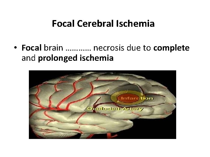Focal Cerebral Ischemia • Focal brain ………… necrosis due to complete and prolonged ischemia