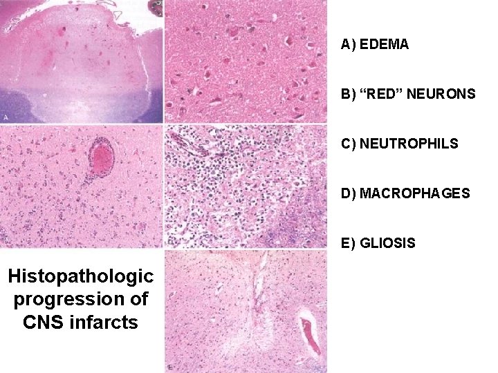 A) EDEMA B) “RED” NEURONS C) NEUTROPHILS D) MACROPHAGES E) GLIOSIS Histopathologic progression of