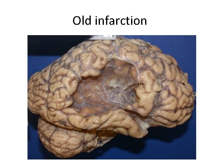 Old infarction 