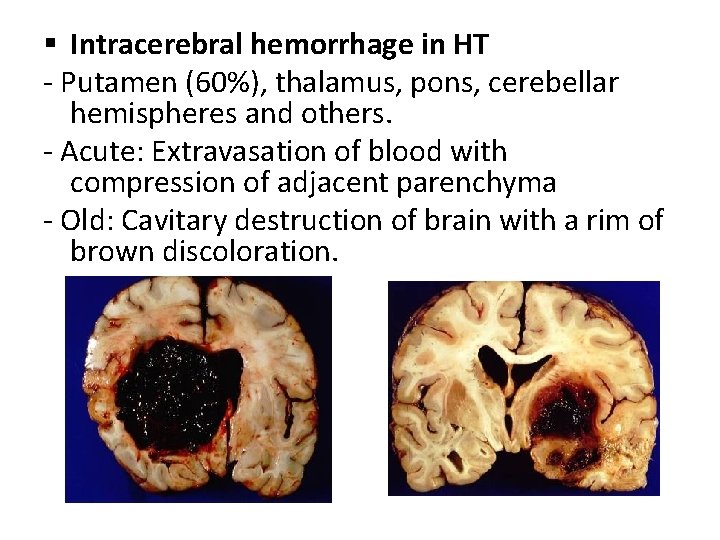 § Intracerebral hemorrhage in HT - Putamen (60%), thalamus, pons, cerebellar hemispheres and others.