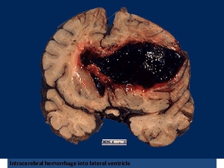 Intracerebral hemorrhage into lateral ventricle 