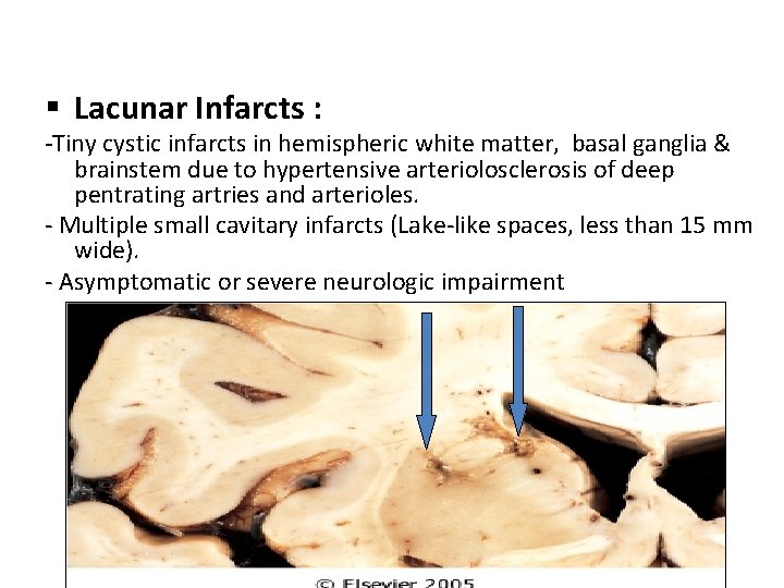 § Lacunar Infarcts : -Tiny cystic infarcts in hemispheric white matter, basal ganglia &